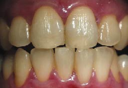 Teeth Whitening Before