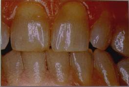 Teeth Whitening Before and After set 2