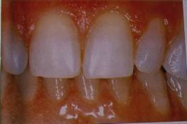 Teeth Whitening Before and After set 2